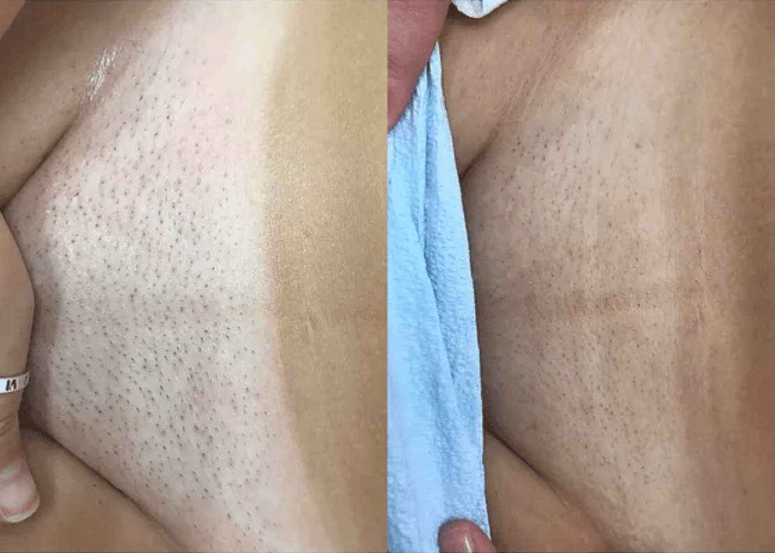 Laser Hair Removal