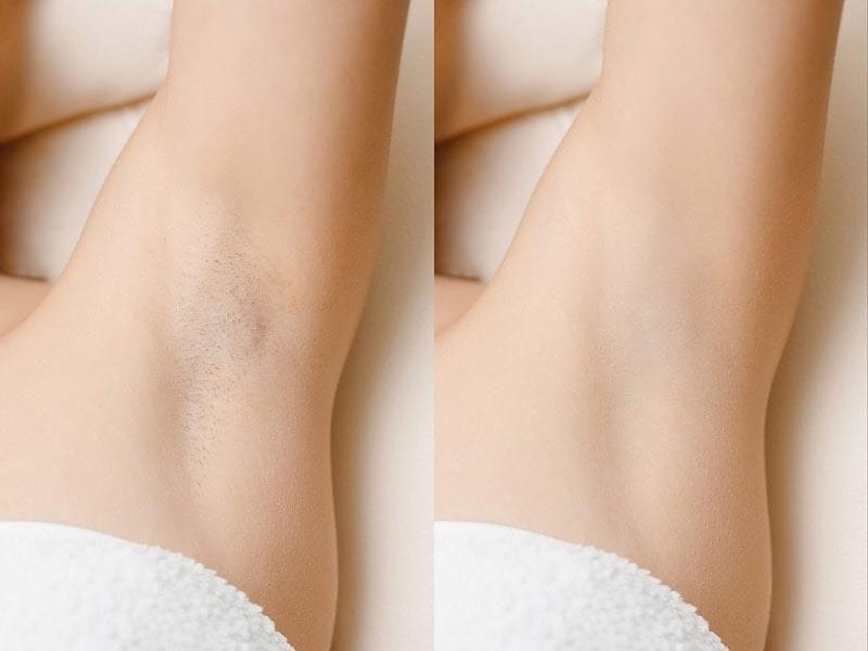 Laser Armpit Hair Removal